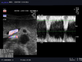 Ultrazvok ledvic - barvni in pulzni dopler desne ledvične arterije normalen ultrazvočni izvid